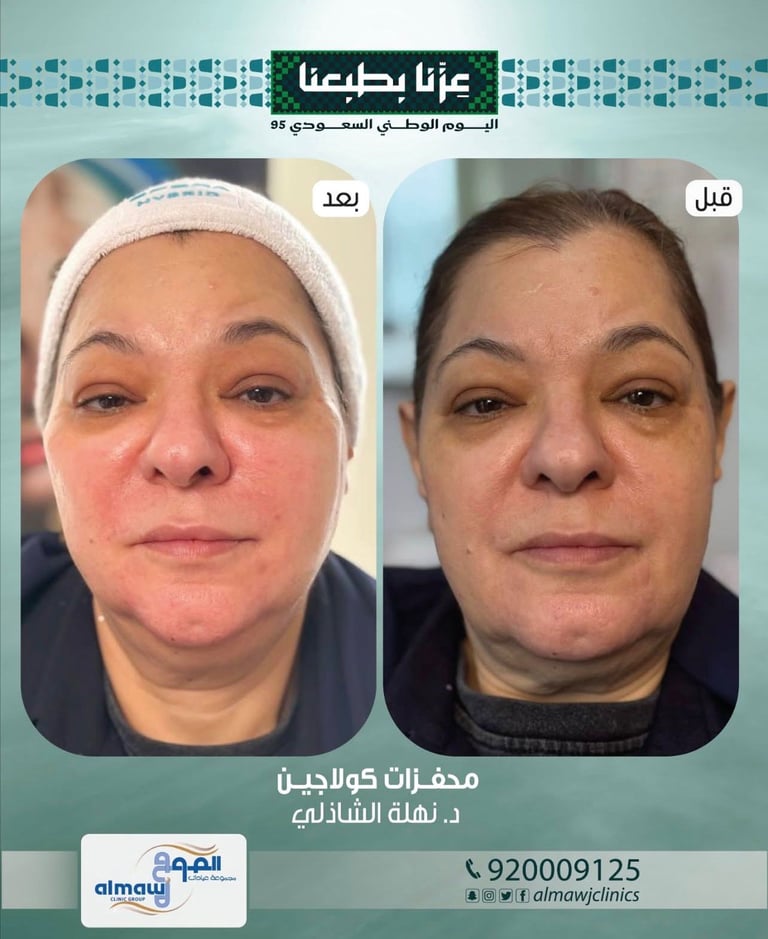 قبل وبعد علاج الوجه