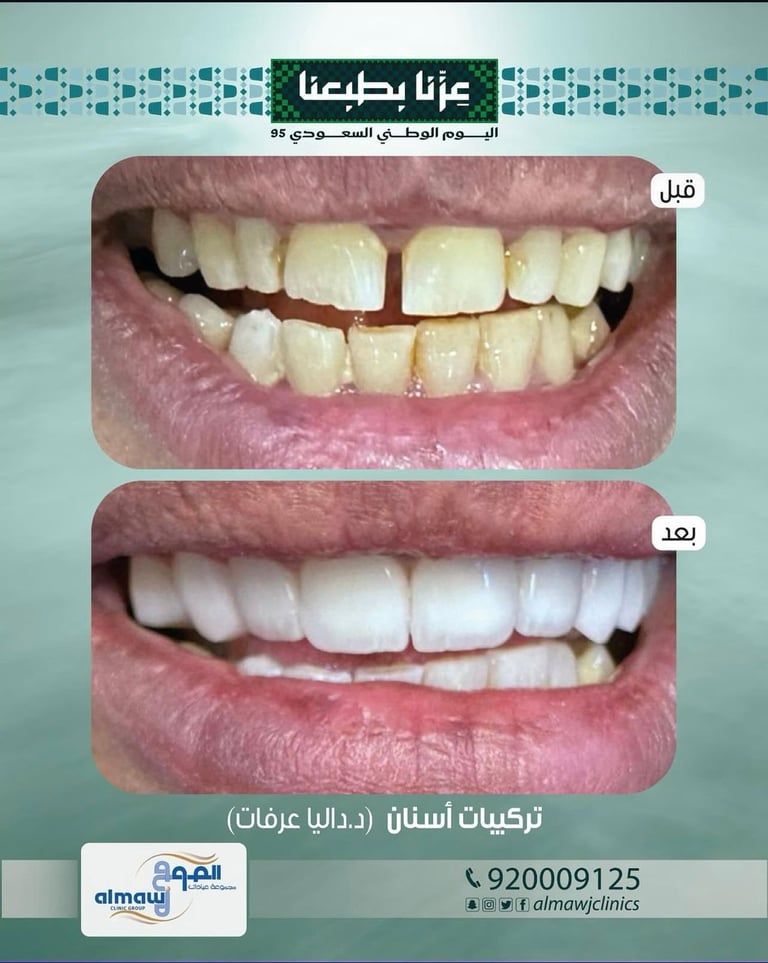 قبل وبعد قشور الأسنان