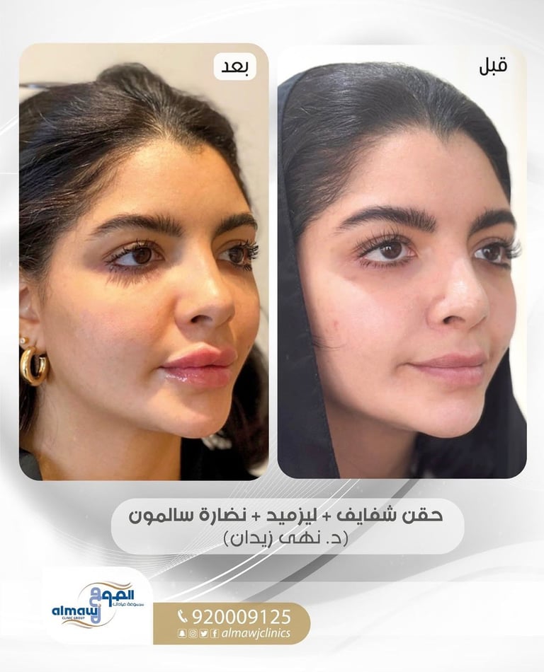 قبل وبعد هايدرفيشل