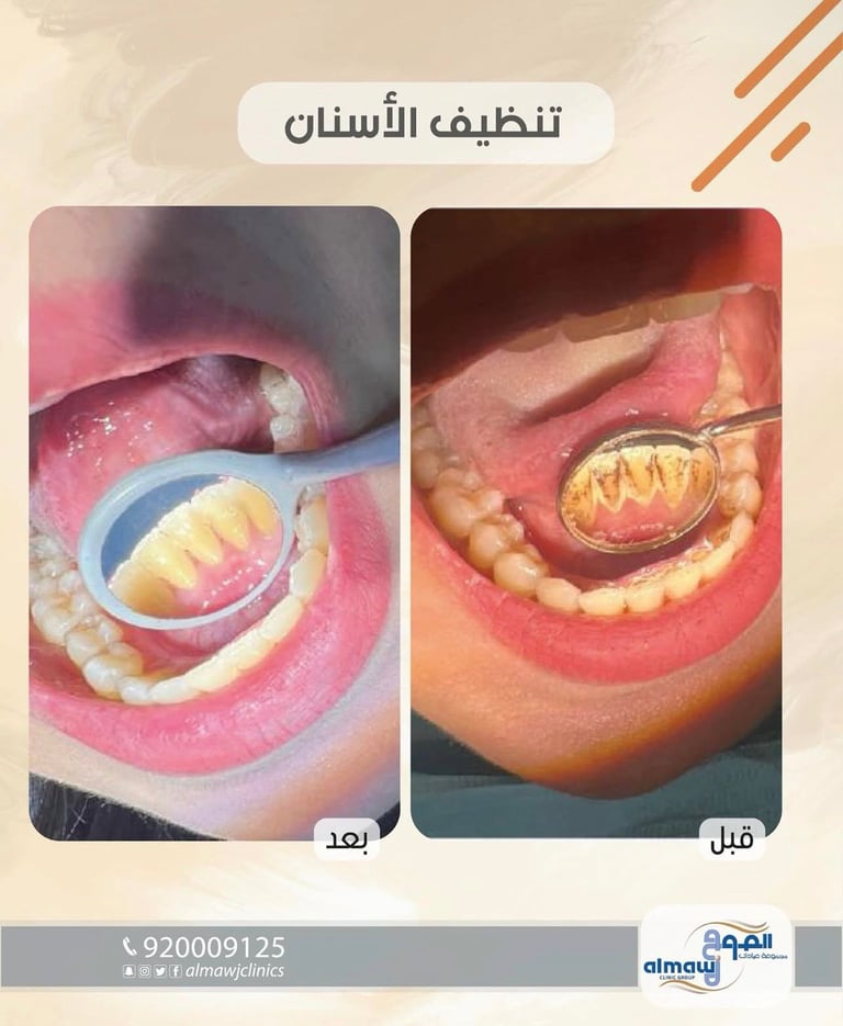قبل وبعد تنظيف الأسنان